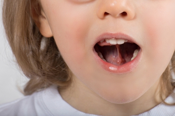 magazin kinder zungenbändchen california smile kieferorthopädie münchen