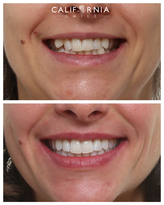 magazin black corridors vorher nachher california smile kieferorthopädie münchen